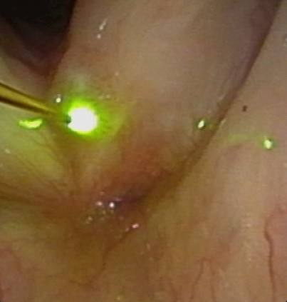 Papillome während der KTP-Laserung,